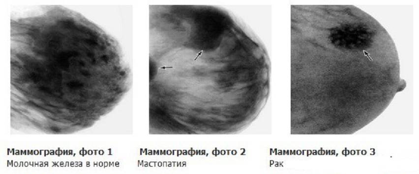 Лимфостаз — симптомы, диагностика, лечение