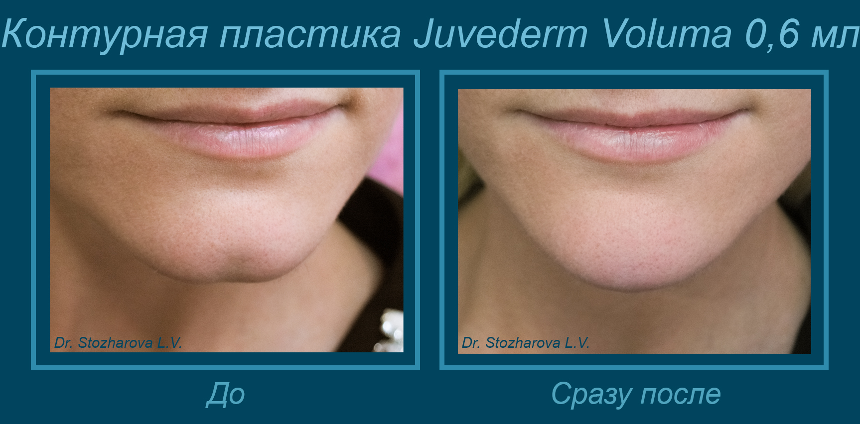 Что означает ямочка на подбородке и как ее можно убрать | smokewoman.ru