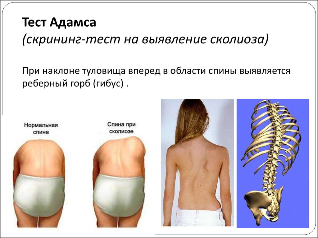 Степени сколиоза