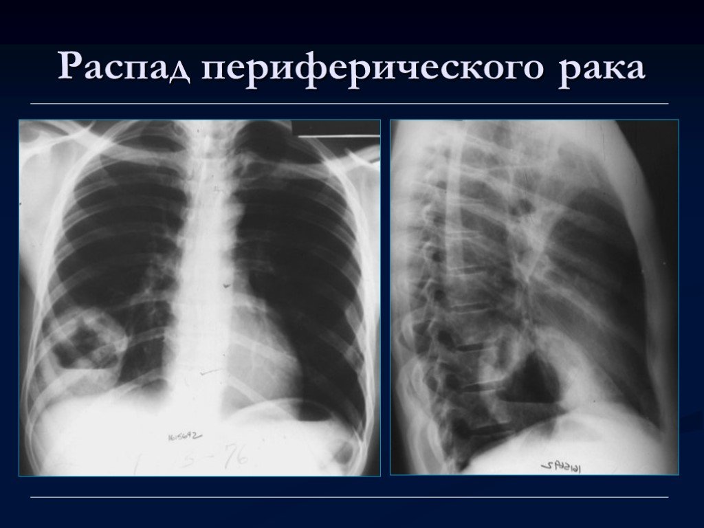 Что такое отек стромы в желудке: причины и симптомы