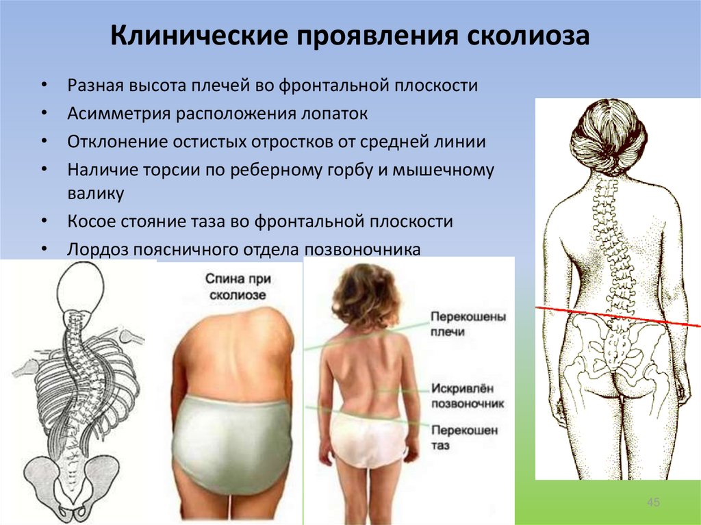 Сколиоз поясничного и крестцового отдела позвоночника 1-4 степени
